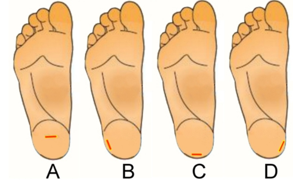 <strong>  Which of the capillary punctures, in this image, is(are) performed correctly? (choose all that apply)</strong> A) Images A, B B) Images B, C C) Images B, D D) Images C, D <div style=padding-top: 35px> 