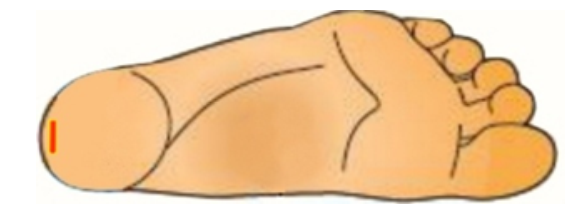 <strong>  If a heelstick is performed with the cut applied as pictured in this image, what may result?</strong> A) Blood will clot before it is able to be collected. B) Blood will not form drops, but rather run along the back of the heel. C) The heel bone may become infected because there is less tissue in this area. D) No adverse situations will occur because this is the appropriate area for heelstick. <div style=padding-top: 35px> 