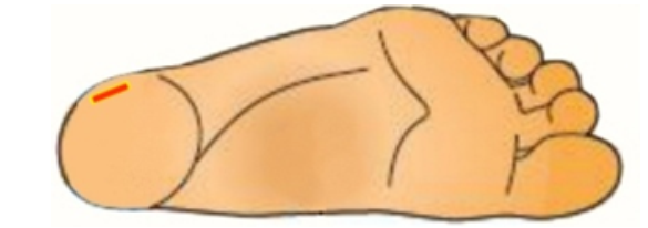 <strong>  If a heelstick is performed with the cut applied as pictured in this image, what may result?</strong> A) Blood will clot before it is able to be collected. B) Blood will not form drops, but rather run along the back of the heel. C) The heel bone may become infected because there is less tissue in this area. D) No adverse situations will occur because this is the appropriate area for heelstick. <div style=padding-top: 35px> 