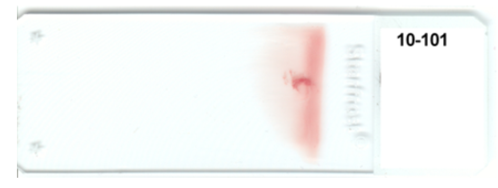   -The appearance of this blood smear is caused by using(check all that apply)  i. too small of a drop of blood ii. too slow of a spreading speed iii. too steep of an angle of the spreader slide iv. a start and stop motion A)  i and ii B)  ii and iv C)  i and iii D)  ii and iii 