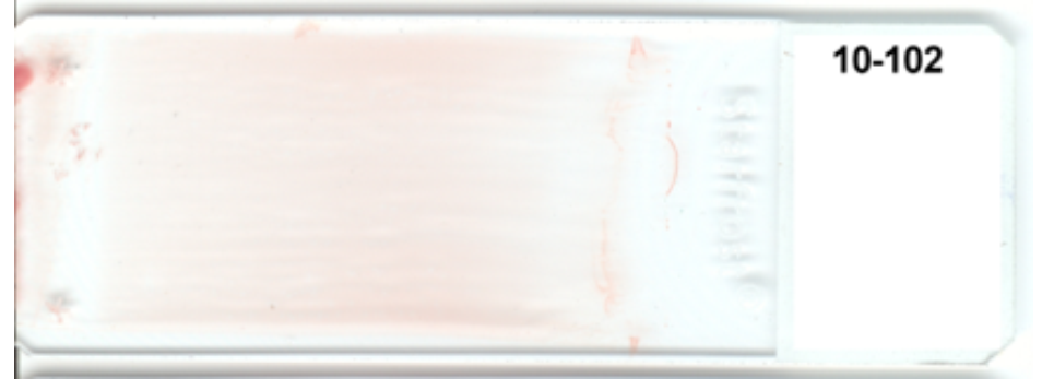   -The appearance of this blood smear is caused by using(check all that apply)  i. too small of a drop of blood ii. too slow of a spreading speed iii. too shallow of an angle of the spreader slide iv. a start and stop motion A)  i and ii B)  ii and iv C)  i and iii D)  ii and iii 