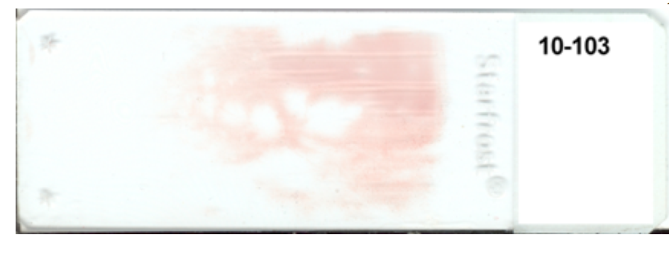   -The appearance of this blood smear is caused by using (check all that apply)  A)  a slide with fingerprints on it B)  unequal pressure on the spreader slide C)  a chipped slide for the spreader slide D)  a start and stop motion 