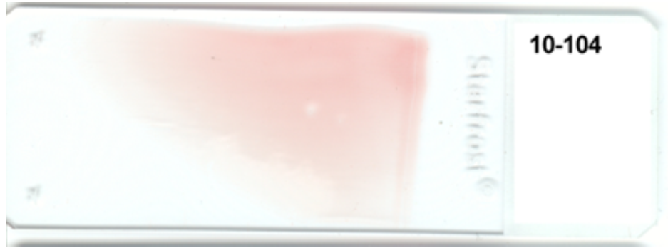   -The appearance of this blood smear is caused by using (check all that apply)  A)  a slide with fingerprints on it B)  unequal pressure on the spreader slide C)  a chipped slide for the spreader slide D)  a start and stop motion 