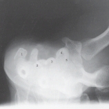 This projection is performed to rule out:   A)  median nerve impingement. B)  calcification in carpal sulcus. C)  carpal tunnel syndrome. D)  all of the above.