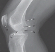 Which of the labeled structures is the lateral condyle of the femur?   A)  A B)  B C)  C D)  D E)  E