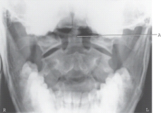 A critique of the image demonstrates which repeatable error?   A)  Excessive flexion of the skull B)  Excessive extension of the skull C)  Mouth not open far enough D)  None of the above are repeatable errors.