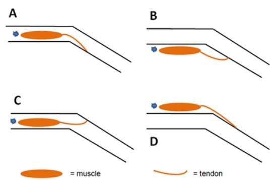 <strong>The figure below represents a joint in the hind leg of a grasshopper. The exoskeleton of the leg is indicated by the two pairs of parallel black lines. A muscle that moves this leg is fixed to the skeleton at the end marked with a blue star. When the muscle contracts, it will pull on the tendon at its opposite end. Which configuration shows the most likely arrangement of the exoskeleton and a muscle that increases the flexion of this leg?  </strong> A) A B) B C) C D) D <div style=padding-top: 35px> 