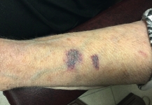   A daughter brings her elderly mother to the outpatient clinic because she has several bruises on her arm. You see the above alteration in skin. You explain to the daughter that these are not bruises but areas of ruptured fragile capillaries causing bruising of the skin. This is called ____________________ ____________________ (two words).