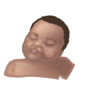   You are inspecting the face of a newborn infant and note pearly white spots on the newborn's nose as seen in the above picture. These spots are called ____________________.