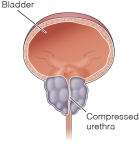   The nurse has performed a digital rectal examination and found the following findings that are seen in this picture. What is the name of the condition? ____________________ ____________________ ____________________