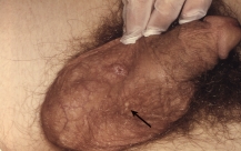   You are inspecting the skin of a middle-aged man and see these yellow-white papules on the skin of the penis. They are called _____________ _____________.