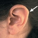   You are assessing an ear and see this deviation. What is the name of the assessment finding shown in the photo? A)  Cyst B)  Darwin tubercle C)  Tophi D)  Tragus 
