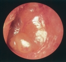   You are performing an inner ear assessment. What is your assessment finding based on the photo above? A)  Normal finding B)  Otitis media C)  Ruptured tympanic membrane D)  Cerumen buildup 