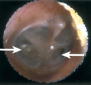   The patient comes to urgent care complaining of ear pain. You assess the ear using an otoscope. What is your assessment finding? A)  Otitis media B)  Normal finding C)  Ruptured tympanic membrane D)  Cerumen 