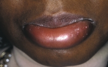 <strong>  A patient comes to the emergency room stating that he woke up this morning with swollen lips. He reports that he has just started a new medication for his allergies. What is the name of this condition?</strong> A) Anaphylaxis B) Angioedema C) Herpes simplex D) Angular cheilitis <div style=padding-top: 35px> 