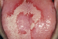 <strong>  You are assessing this patient's tongue and note that patches on the tongue are missing papillae. What is the name of this condition?</strong> A) Atrophic glossitis B) Hairy tongue C) Geographic tongue D) Leukoplakia <div style=padding-top: 35px> 