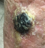   A patient is at his dermatologist's office to have a skin lesion on his face evaluated. The health-care provider tells that patient that she is going to do a biopsy to rule out ___________________ cell carcinoma, a malignant cutaneous malignancy arising from keratinocytes of the skin.