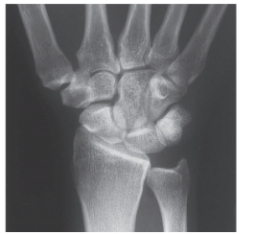 <strong>   -Refer to the figure. Name the view.</strong> A) Anteroposterior (AP) hand B) AP wrist C) Posteroanterior (PA) hand D) PA wrist <div style=padding-top: 35px> 