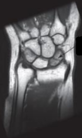 <strong>   -Refer to the figure. The arrow is pointing to a:</strong> A) Tear of the triangular fibrocartilage complex B) Fracture of the scaphoid C) Avascular necrosis of the lunate D) Fracture of the capitate <div style=padding-top: 35px> 