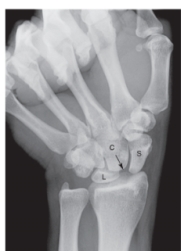 <strong>   -Refer to the figure. Name the view.</strong> A) Ulnar deviation B) PA wrist C) Radial deviation D) Clenched fist <div style=padding-top: 35px> 