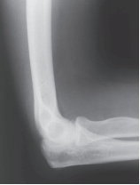   -A soft tissue sign associated with the projection in the question 1 figure is known as the fat pad sign. A positive fat pad sign is caused by: A)  Increased capsular volume B)  Extra adipose tissue C)  Poor radiographic positioning D)  Artifact