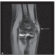   -Refer to the figure. The increased edema at the origin of the common flexor tendon indicated by the arrow suggests: A)  Medial epicondyle fracture B)  Lateral epicondyle fracture C)  Medial epicondylitis D)  Lateral epicondylitis