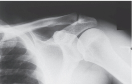 <strong> -Refer to the figure. Name the radiographic projection.</strong> A) Anteroposterior external rotation B) Lateral view of the scapula C) Anteroposterior internal rotation D) Axillary view of glenohumeral joint