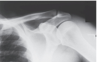 <strong> -Refer to the figure. You have chosen the correct answer because you recognized what region of anatomy seen in profile?</strong> A) Greater tuberosity B) Acromioclavicular joint C) Lesser tuberosity D) Coracoid process