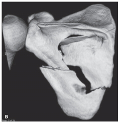 <strong> -Refer to the figure. Describe the pathological condition.</strong> A) Osteolytic destruction B) Degenerative joint disease C) Fracture of the scapula D) Dislocation of the glenohumeral joint