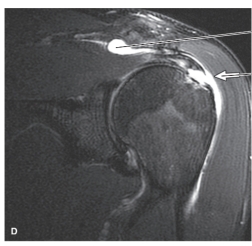 <strong> -Refer to the figure. Contrast has been added to the ______________joint. This procedure is called _________________.</strong> A) glenohumeral; myelography B) acromioclavicular; arthrography C) coracoclavicular; arthrography D) glenohumeral; arthrography