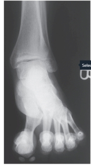   -Refer to the figure. Name the radiographic view. A)  Anteroposterior B)  Lateral C)  Anteroposterior obliques (mortise) 