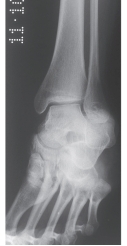   -Refer to the figure. On this standard view, which of the following is not well visualized? A)  Distal tibia B)  Distal fibula C)  Subtalar joint D)  Talar dome