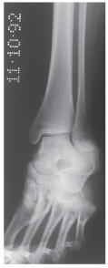   -Refer to the figure. This view allows for optimal assessment of the: A)  Talar dome B)  Subtalar joint C)  Lateral malleoli D)  Midtarsal joint