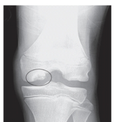 <strong>   -Refer to the figure. Name the view.</strong> A) Anteroposterior B) Lateral C) PA axial tunnel D) Tangential view of the patellofemoral joint <div style=padding-top: 35px> 