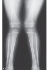 <strong>   -Refer to the figure. What is the defect in the circle? Hint: This is the most common location for this lesion.</strong> A) Osteochondritis dissecans B) Fracture C) Ewing's sarcoma D) Osgood-Schlatter disease <div style=padding-top: 35px> 
