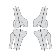 <strong>   -Refer to the figure. The developmental deformity shown here is described as:</strong> A) Bilateral genu varum B) Bilateral genu valgus C) Ipsilateral genu valgus D) Contralateral genu varum <div style=padding-top: 35px> 