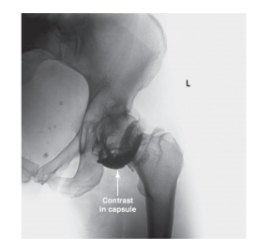   -Refer to the figure. What is the diagnostic purpose of the contrast? A)  Evaluate the joint cartilage B)  Identify stress fracture C)  Determine vascularity D)  Stage a tumor