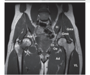   -Refer to the figure. What does the arrow point to? A)  Hip arthroplasty B)  Infection C)  Avascular necrosis D)  Fracture