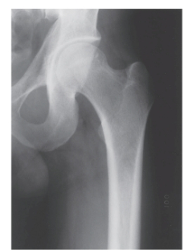   -Refer to the figure. Identify the radiographic view. A)  Anteroposterior radiograph of the hip B)  Lateral radiograph of the hip C)  Lateral  frog-leg  radiograph of the hip D)  Oblique view of the hip