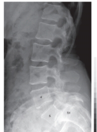 <strong> -Refer to the figure. Name the view.</strong> A) Anteroposterior view of the lumbar spine B) Anteroposterior view of the lumbosacral spine C) Oblique view of the lumbosacral spine D) Lateral view of the lumbosacral spine
