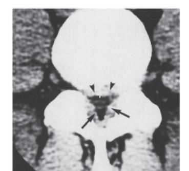 <strong> -Refer to the figure. Name the image and pathological condition.</strong> A) Sagittal MRI, stenosis B) Axial MRI, vertebral compression C) Sagittal CT, spondylolisthesis D) Axial CT, stenosis