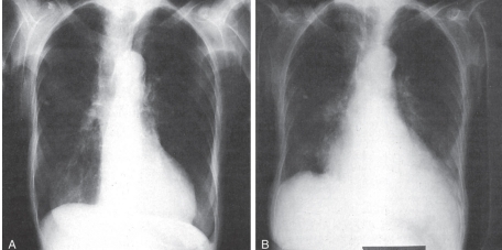   -Refer to the figure. Both radiographs of the chest are normal. Which patient was radiographed in a PA (posteroanterior)  projection? A)  Patient A B)  Patient B