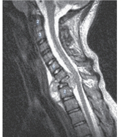 <strong>   -Refer to the figure. What vertebrae has undergone complete destruction?</strong> A) Seventh cervical vertebra B) Eighth cervical vertebra C) First thoracic vertebra D) Second thoracic vertebra <div style=padding-top: 35px> 