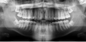 <strong> -Refer to the figure. What is the imaging method used in this image?</strong> A) 3D scan B) CT, soft tissue window C) Panoramic radiograph D) Transcranial radiograph