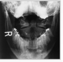   -Refer to the figure. What is most significant to identify on this view? A)  Position of the mandible B)  The C1-C2 disc space C)  Symmetry of the C1-C2 articulation D)  Cervical lordosis