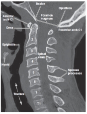   -Refer to the figure. The spinal canal is visible in its full anteroposterior diameter. Why is this possible? A)  This slice is reformatted at the midline B)  Bony pedicles and lamina are not well visualized on CT C)  The spinal cord has a greater density than the spinal canal D)  The spinal canal is only visible on an axial view.