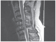   -Refer to the figure. The anterolisthesis of C6 on C7 has resulted in abnormal compression of the: A)  Spinal cord B)  Spinal nerve root C)  Intervertebral disk D)  Vertebral body
