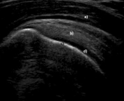 <strong> -Refer to the figure. What are the structures marked a-d in this normal longitudinal ultrasound of the shoulder?</strong> A) (a) deltoid muscle, (b) subacromial bursa, (c) cancellous bone, (d) synovial fluid B) (a) subacromial bursa, (b) supraspinatus muscle, (c) cortical bone, (d) articular cartilage C) (a) subdeltoid bursa, (b) supraspinatus tendon, (c) cancellous, (d) articular capsule D) (a) deltoid muscle, (b) supraspinatus tendon, (c) cortical bone, (d) articular cartilage