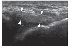 <strong> -Refer to the figure. What is the structure between the arrowheads?</strong> A) Muscle B) Ligament C) Bursa D) Subcutaneous fat