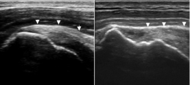 <strong> -Refer to the figure. If you compare the longitudinal ultrasound scan of the supraspinatus muscle and tendon (arrowheads) on the right with the normal supraspinatus on the left, what are your findings?</strong> A) Thickened supraspinatus tendon B) Swollen subacromial bursa C) Cortical irregularities and a partial tear D) Hyperechoic focus in the distal tendon